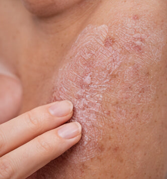 Psoriasis